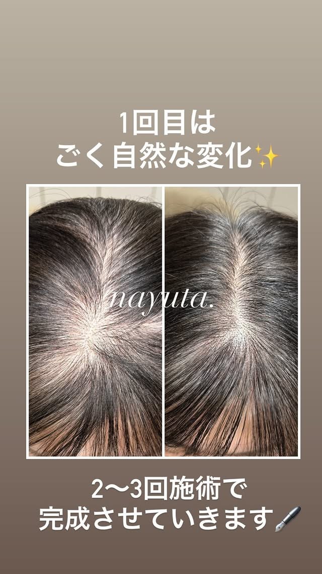 ヘアタトゥー症例：分け目・つむじの施術前後