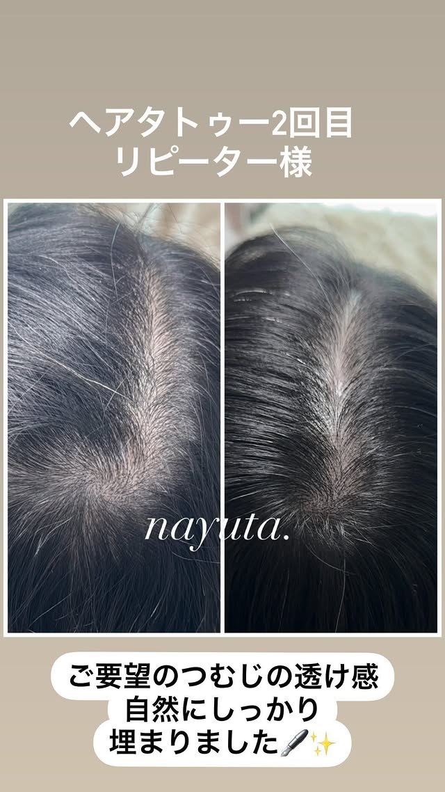 ヘアタトゥー症例：つむじの施術前後