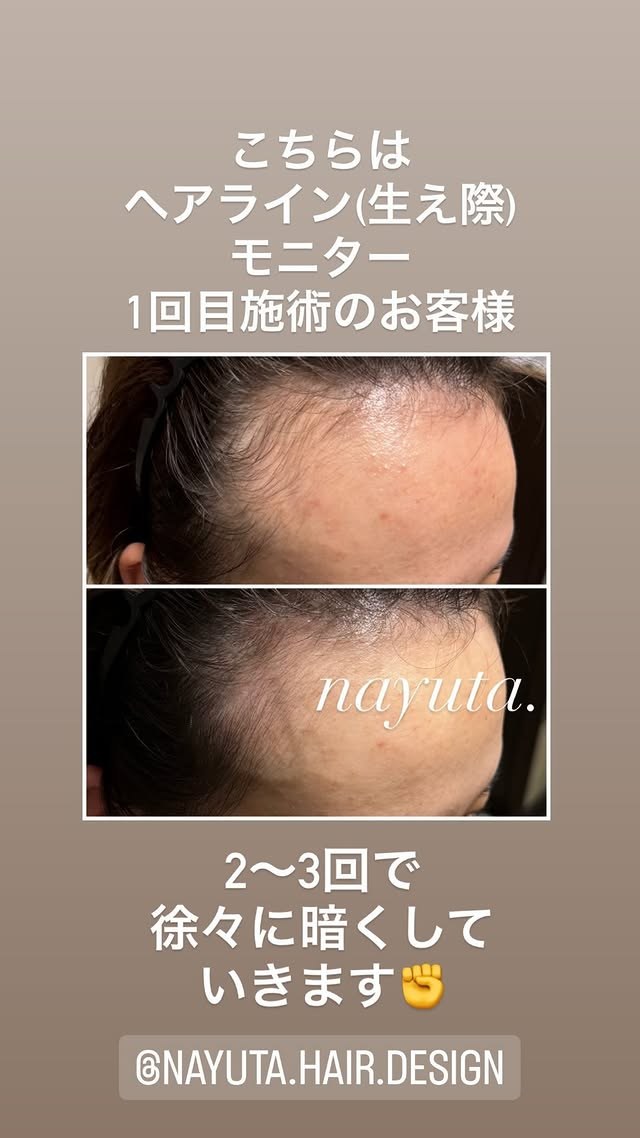 ヘアタトゥー症例：生え際の施術前後